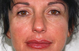 Rajeunissement facial par dermographie