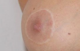 dermographie medicale areoles seins