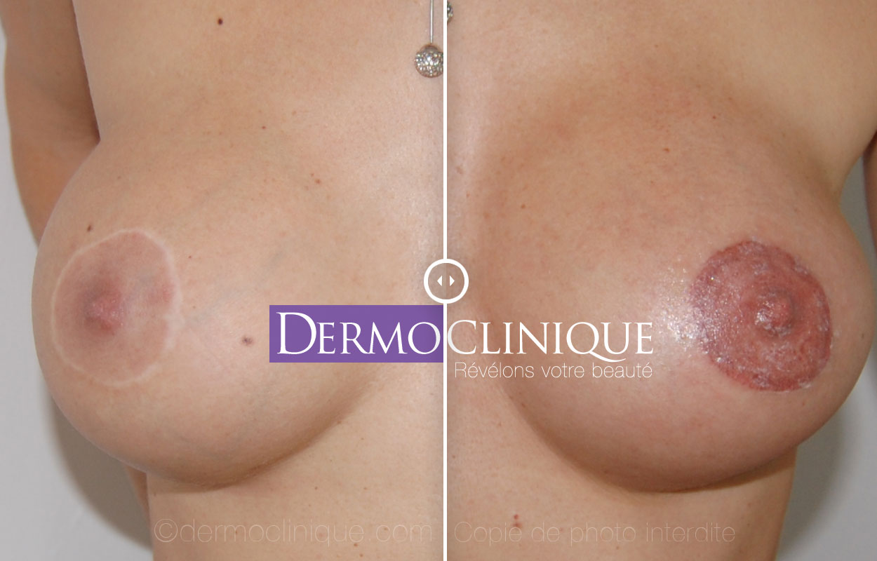 Dermopigmentation seins