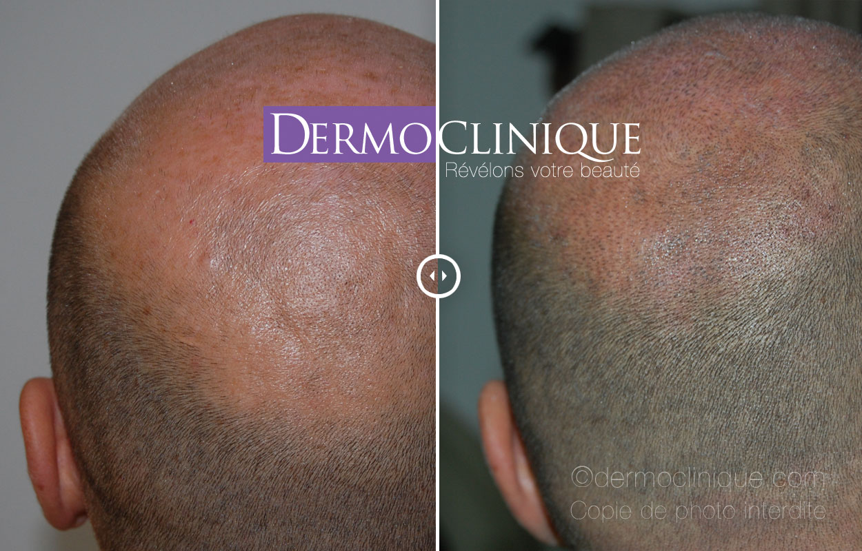 dermopigmentation de la calvitie