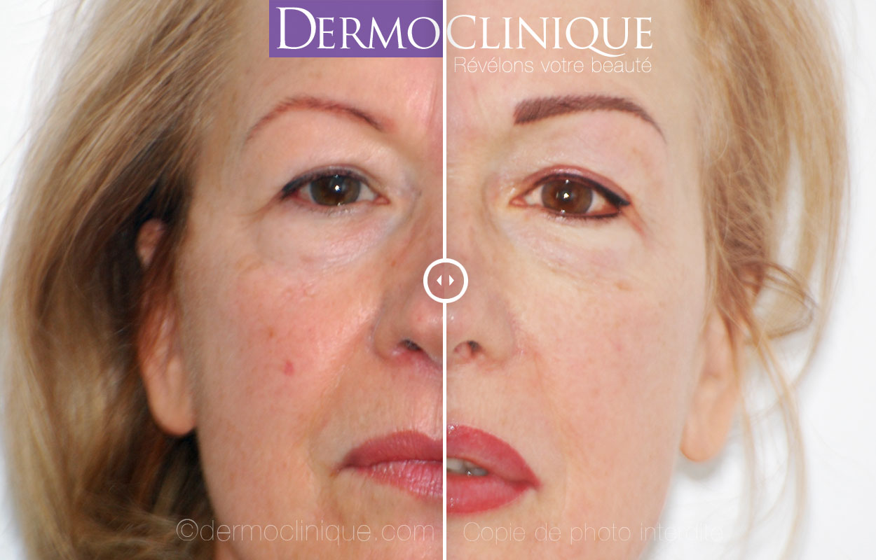 Rajeunissement facial par dermopigmentation